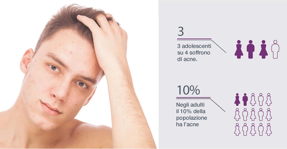 Cancellare l’acne non è solo risolvere un problema estetico brochure