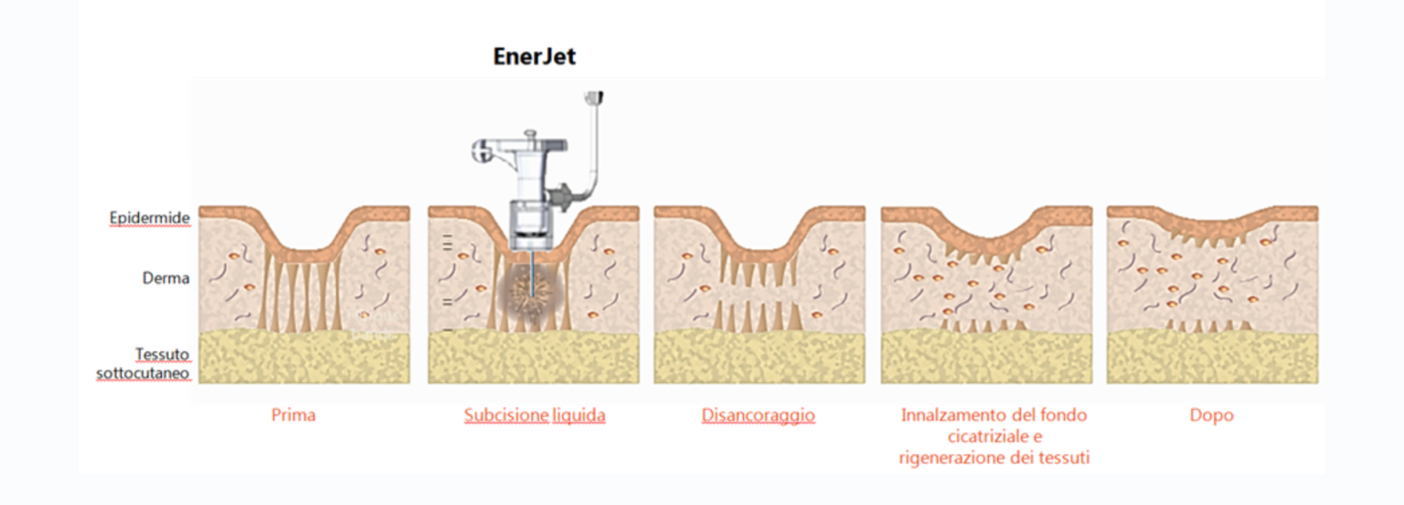 Chirurgia Plastica Frenello | Enerjet™ 2.0