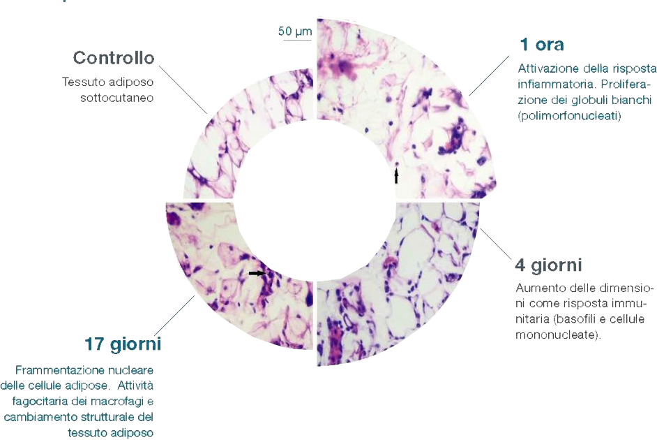 Chirurgia Plastica Frenello | Criolipolisi (o crioadipolisi)