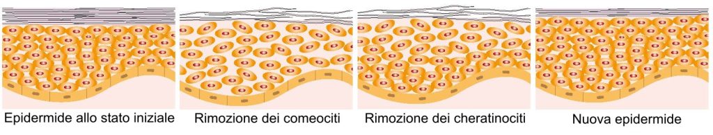 Chirurgia Plastica Frenello | In cosa consiste il peeling chimico e come realizzarlo: il sistema Enerpeel